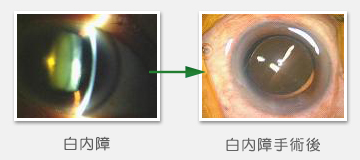 白内障→白内障手術後