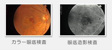 眼底検査　図